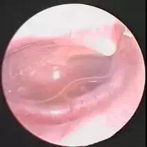 早上睡醒耳朵里有水是怎么回事,耳朵感觉有水但是干的怎么回事