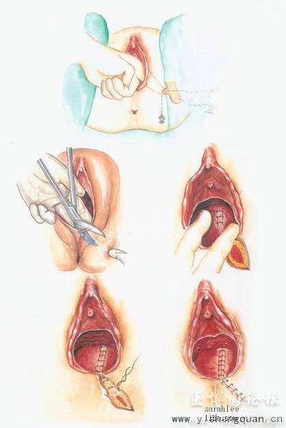 顺产有侧切痔疮不敢大便怎么办,产后痔疮和侧切要吃什么调理