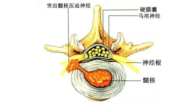 十天治好腰椎间盘突出爬行视频,蜥蜴爬行能治疗腰椎间盘突出