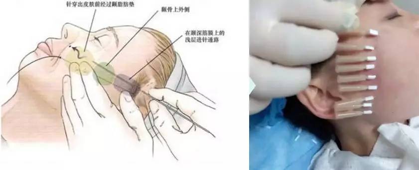 有人劝你打玻尿酸,打玻尿酸的一些常识问题