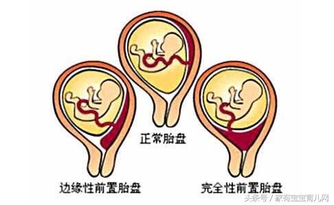 孕期见红会流产吗？有些出血很正常需要注意的是这5种情况！