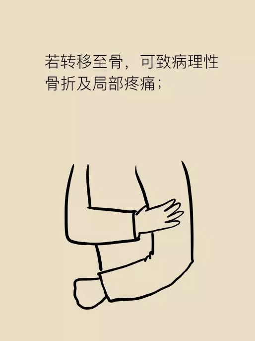 肝癌科普动画,肝癌的形成过程漫画