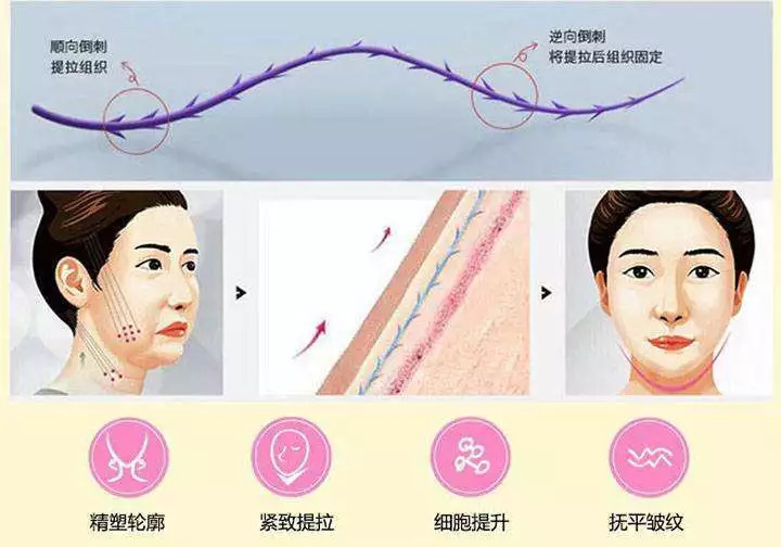 你知道线雕保容颜，却不知道是否适合你？