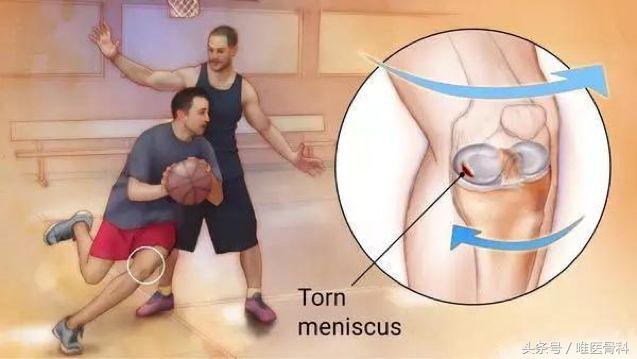 nba半月板损伤都是怎么恢复的,nba球星半月板损伤恢复比较好的