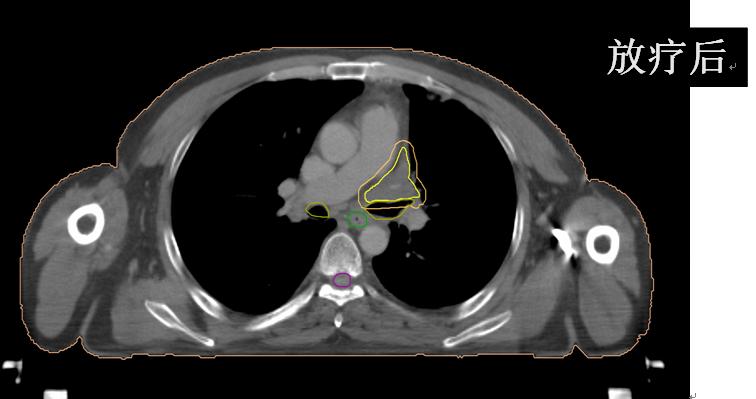安罗替尼治小细胞肺癌吗,卡瑞利珠能治小细胞肺癌吗