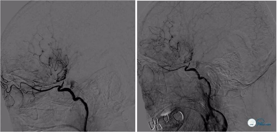 天坛医院住院日记,颈内动脉c5到c7段狭窄微创手术