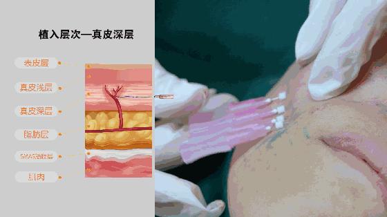 有法令纹很显老怎么办,法令纹木偶纹哪个显老