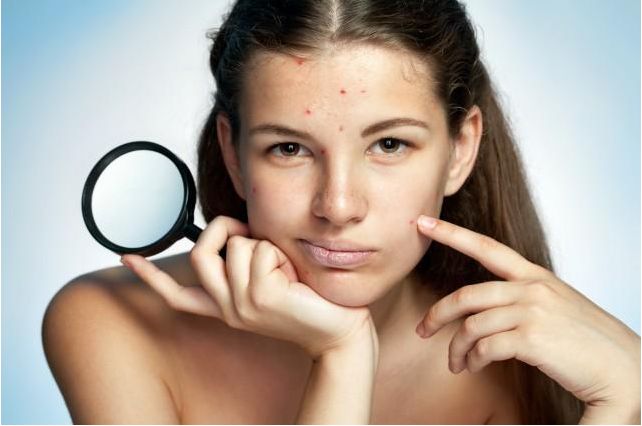 青春痘疤痕消除的药膏,青春痘疤痕图