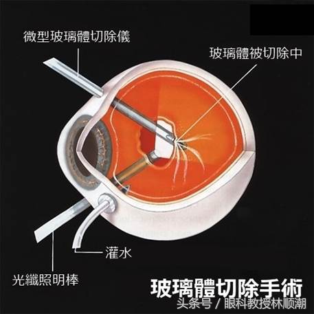 眼睛有飞蚊会导致视网膜脱落吗,有飞蚊症还闪光是视网膜脱落吗