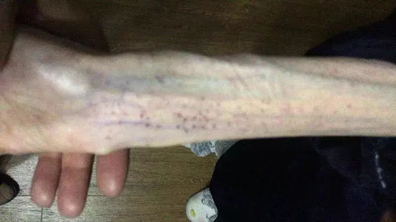 1米67才50斤！21岁女孩自杀式减肥，脑组织如60岁，沉睡40天后竟然……