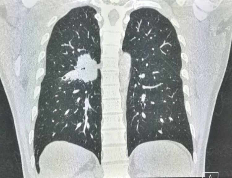 年轻人切除一个肾脏,切除一个肾脏手术全过程