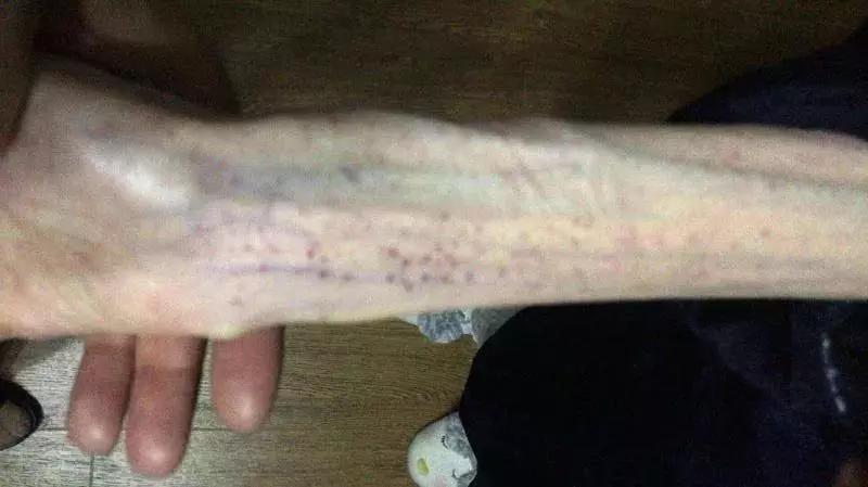 1米67只剩50斤！21岁女孩“自杀式减肥”，照片不忍直视……