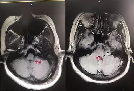 「技术硬实力」不断创新发展的玉田县中医医院脑病四科！