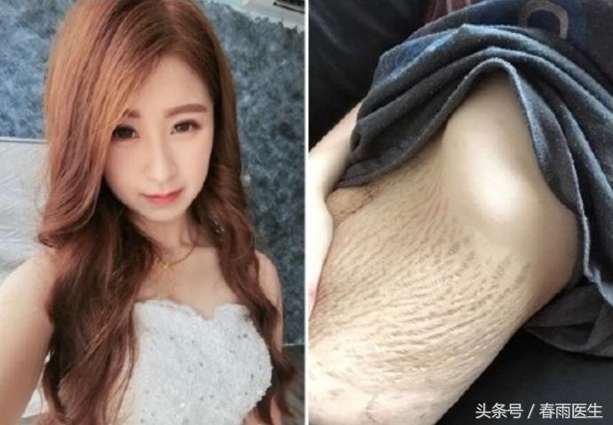 醒醒吧妊娠纹是去除不了的,丑哭的妊娠纹小技能轻松击退