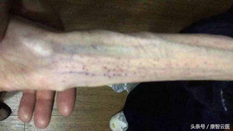 21岁女孩自杀式减肥瘦到50斤 (18岁少女疯狂减肥暴瘦40斤)