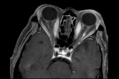 甲状腺相关眼病的科普,甲状腺眼病的临床表现