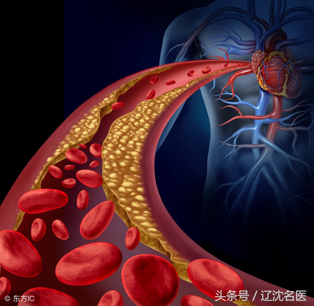 动脉血管瘤引起的蛛网膜下腔出血,动脉血管瘤压迫神经