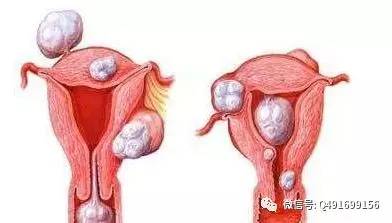 女性切除卵巢子宫后有无影响,子宫切除影响女性快乐感