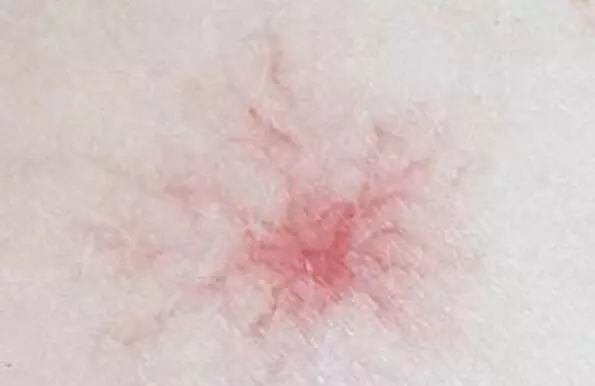身上出现小红痣是什么原因造成的,身上出现小红痣有什么征兆