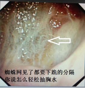 胸水为什么会抽不到,胸水抽了为什么还呼吸困难