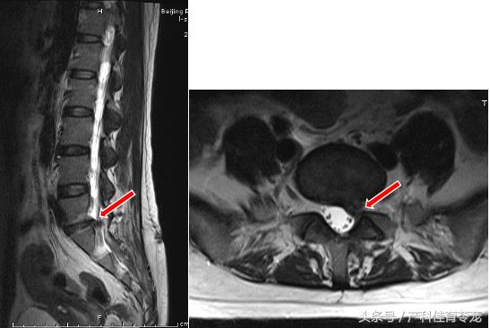 椎间盘突出如何保养防复发,椎间盘突出手术复发后中医治疗