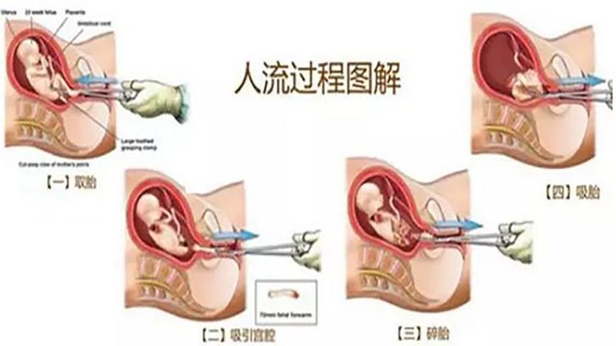 为什么有的女人流产好几次都没事,女性流产几次会导致不孕