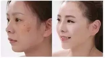 30岁眼角笑起来有皱纹,眼角笑起来有皱纹是老了吗