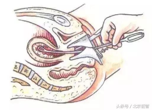 节育环出血的时候能取出来吗,节育环出血时能去取吗