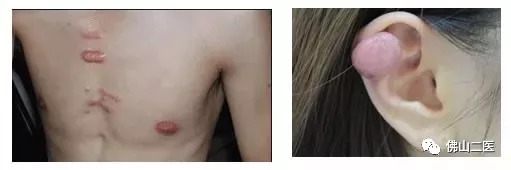疤痕没那么可怕找对方法即可淡疤,有疤痕的你还在为疤痕烦恼吗