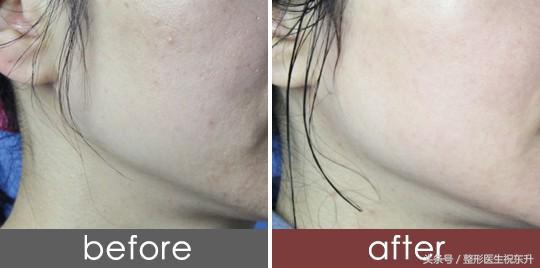 水光针打几针能改善毛孔,水光针打一次效果图