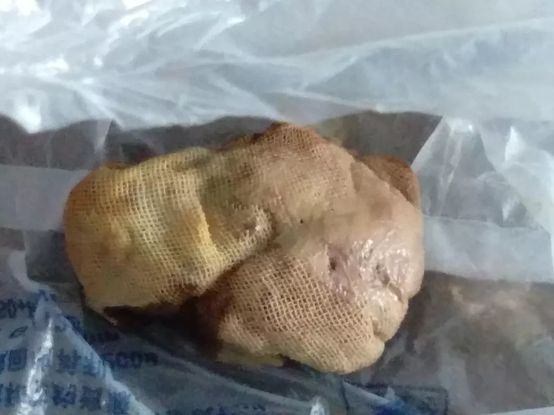 流产手术后三天忽然腹痛,人流后四天肚子痛排出血块