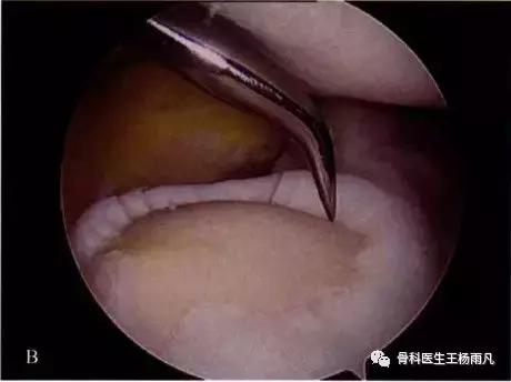 最新的人工膝关节使用寿命,膝关节使用说明