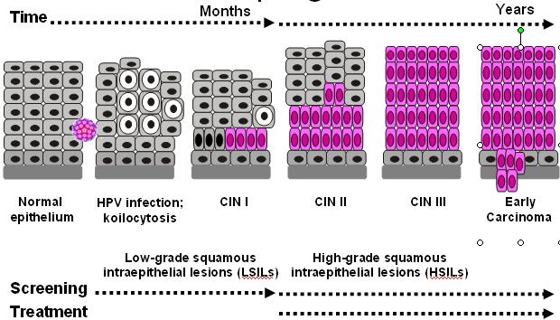 hpv宫颈感染好转症状,宫颈hpv阳性用了药口腔也会变好吗
