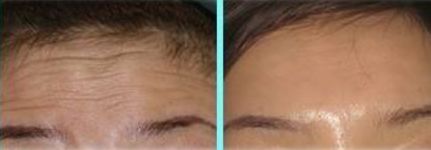 抬头纹很显老别慌教你一个方法,抬头纹太严重怎么解决