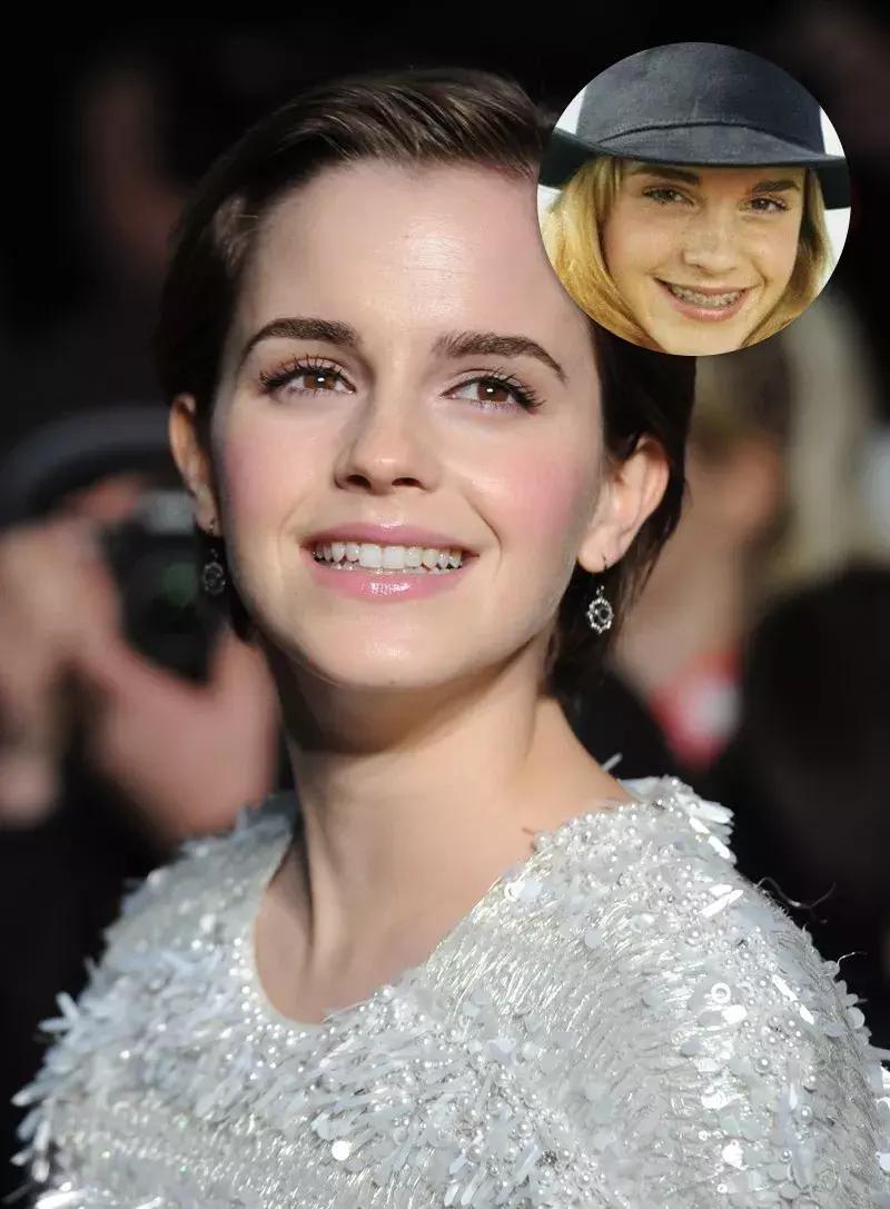 还在犹豫是否整牙，明星们默默变美都在靠它，你想知道的这篇都有