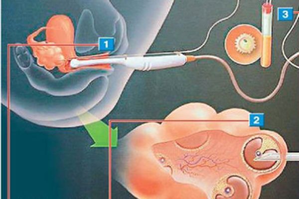 21颗卵卖10000元，17岁少女险丢命！女人一生多少卵子？长点心吧