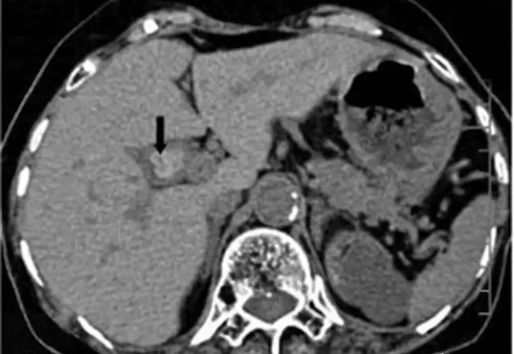 肠息肉和胆囊息肉必须做手术吗,有肠息肉胃息肉胆囊息肉怎么办
