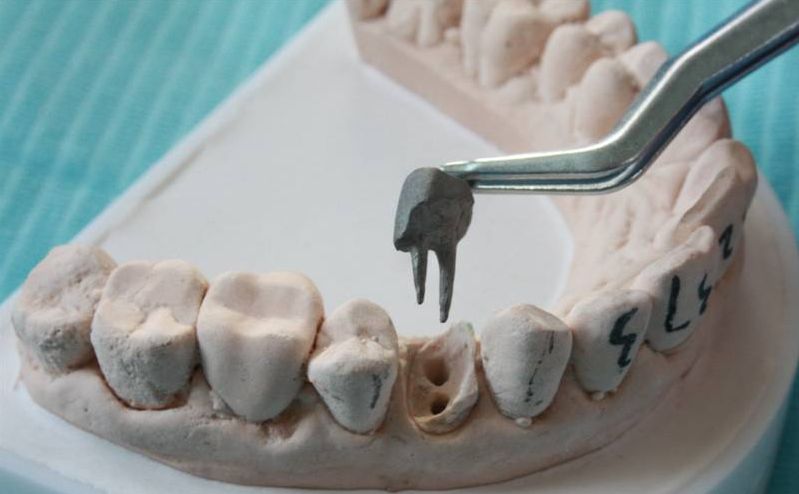 根管治疗后牙齿一定要装牙套吗,根管治疗戴牙冠后有什么感觉