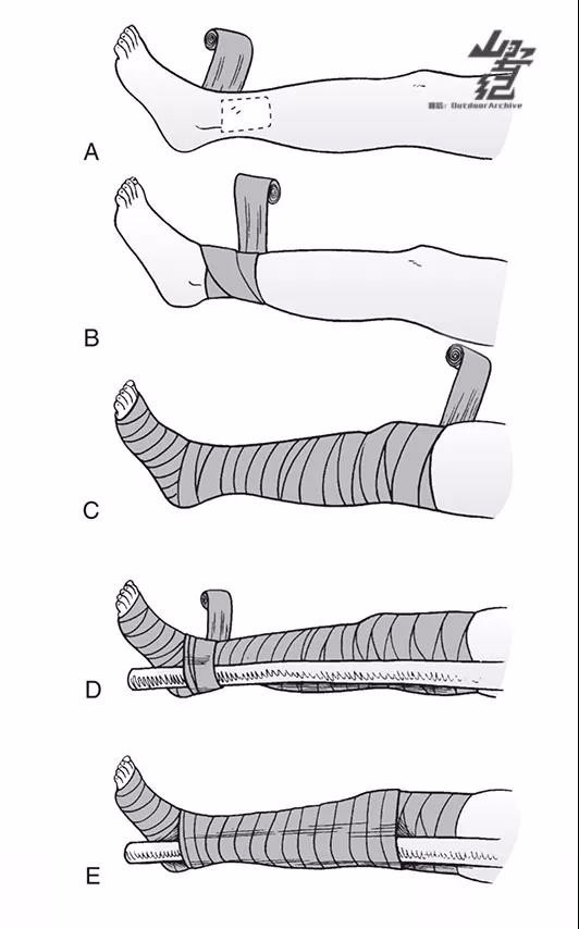 毒蛇咬伤需不需要截肢,被毒蛇咬后截肢会得昂髓炎吗