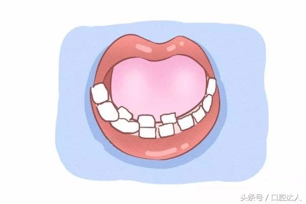 长两排牙的小孩,长了两排牙是怎么回事