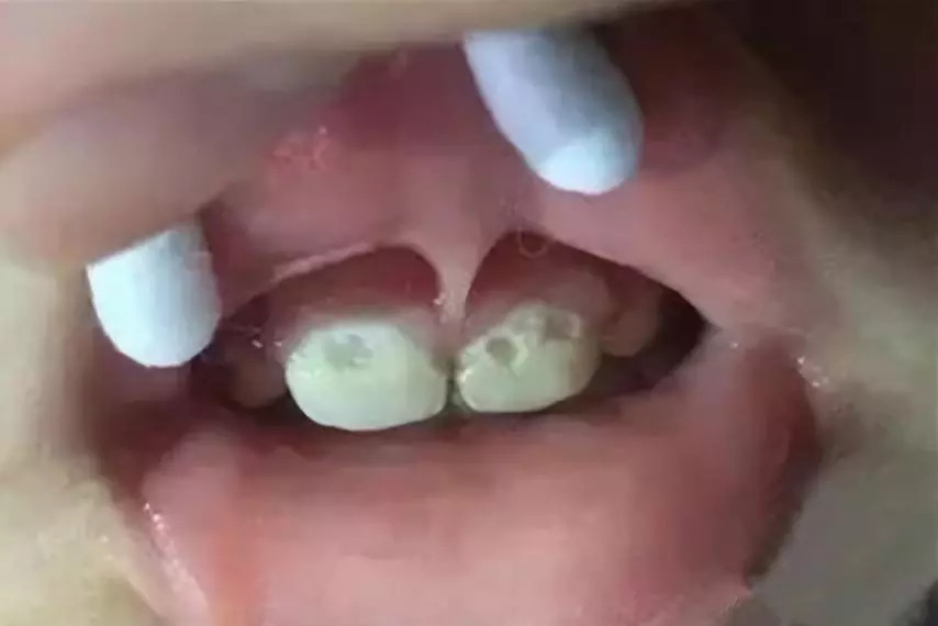 几岁的儿童牙齿就烂了是什么原因,宝宝牙齿烂光了只剩下牙根怎么办