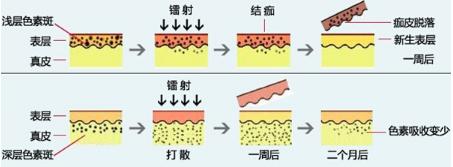 去激光祛斑后怎样才能预防反弹,光子祛斑和激光祛斑后会反弹吗
