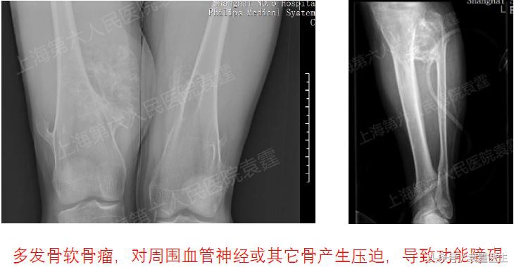 骨软骨瘤肿块比较大是什么原因,腿部骨软骨瘤的症状