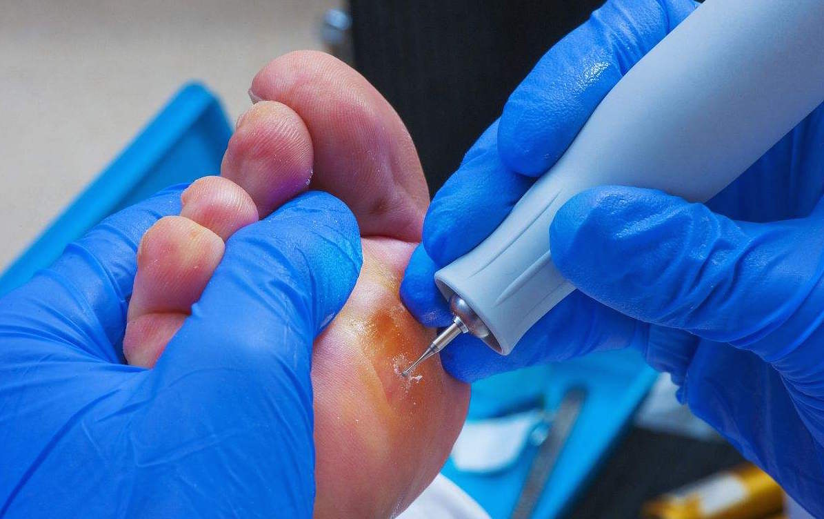 什么是鸡眼和跖疣,什么是鸡眼什么是脚钉