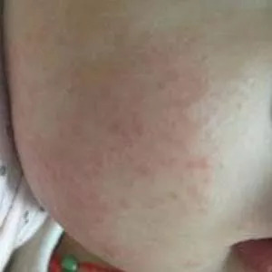 润肤霜怎么治疗湿疹,湿疹治疗误区有哪些呢