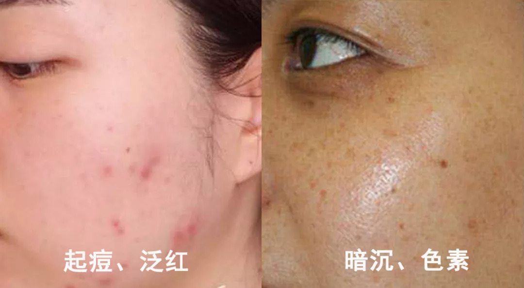 脱发算啥!90后已经开始长“老年斑”了,有人还为此花了10多万!