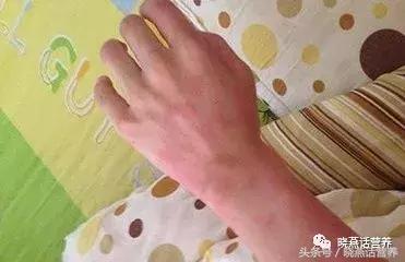 麻疹饮食,麻疹的饮食注意事项