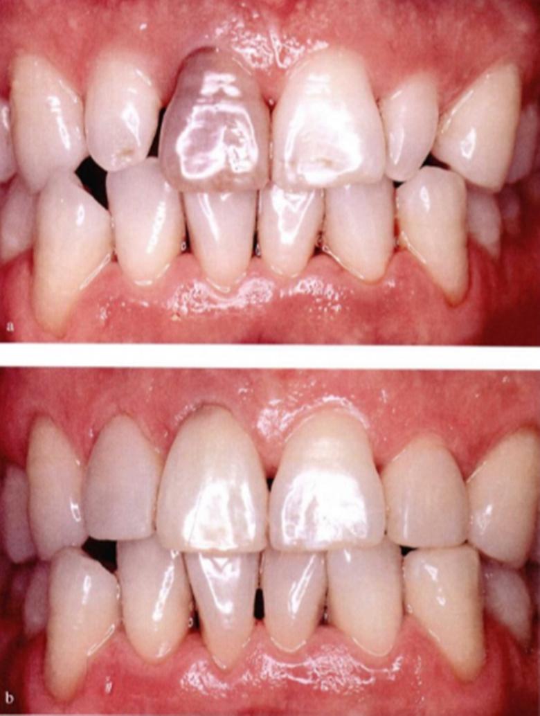 美白牙齿不伤牙齿的方法,牙齿黄不好看怎么美容