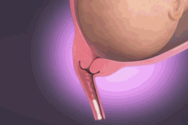 生产前先破水好还是见红好,生产先见红还是先宫缩