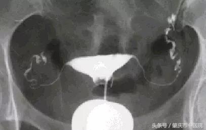 妇科小知识之输卵管堵塞